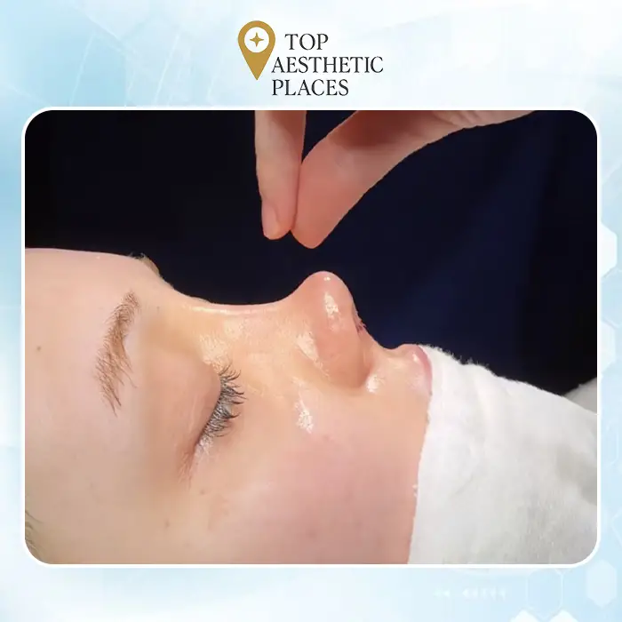 Top 7 Phẫu thuật nâng mũi tại Lai Châu - Được hàng trăm người tin dùng vì kết quả tự nhiên