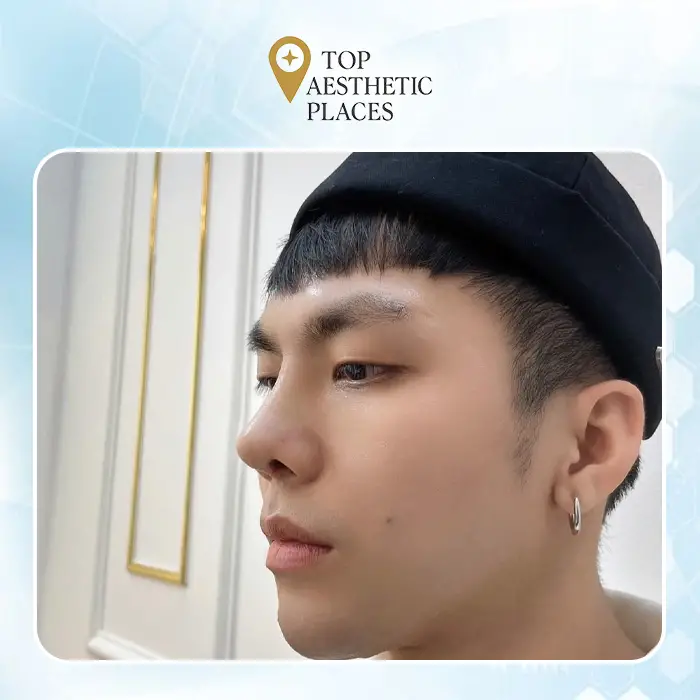 Top 7 Trusted Rhinoplasty in Soc Trang – Professional Care & Proven Results