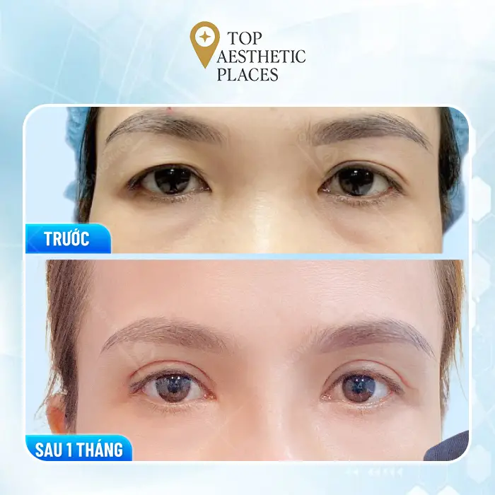 Discover the Top 7 Trusted Blepharoplasty Clinics in Vietnam — Safe & Professional Care