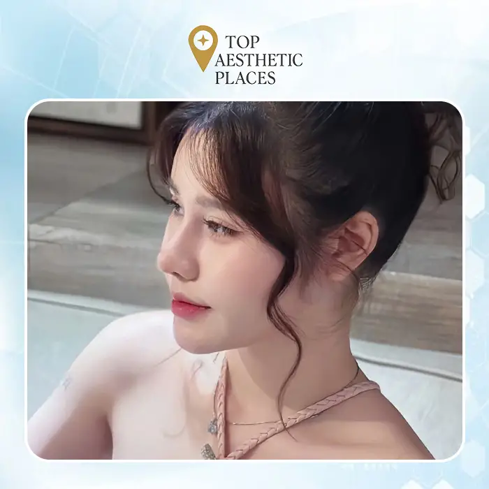 Unveiling the Top 7 Trusted Rhinoplasty in Thanh Hoa