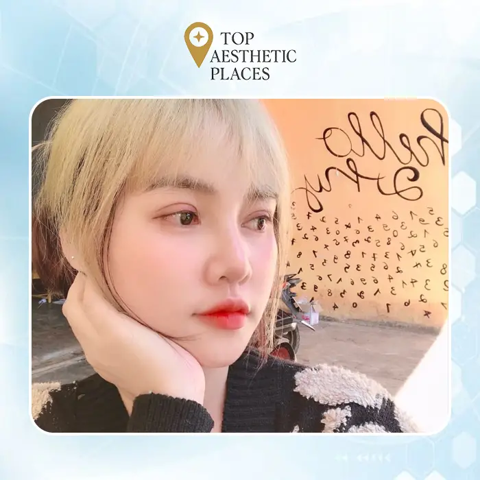 Uncover the Top 7 Trusted Rhinoplasty in Go Vap District, Ho Chi Minh City