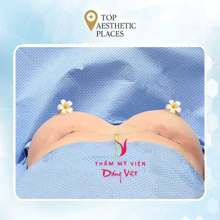 Breast Augmentation in Can Tho