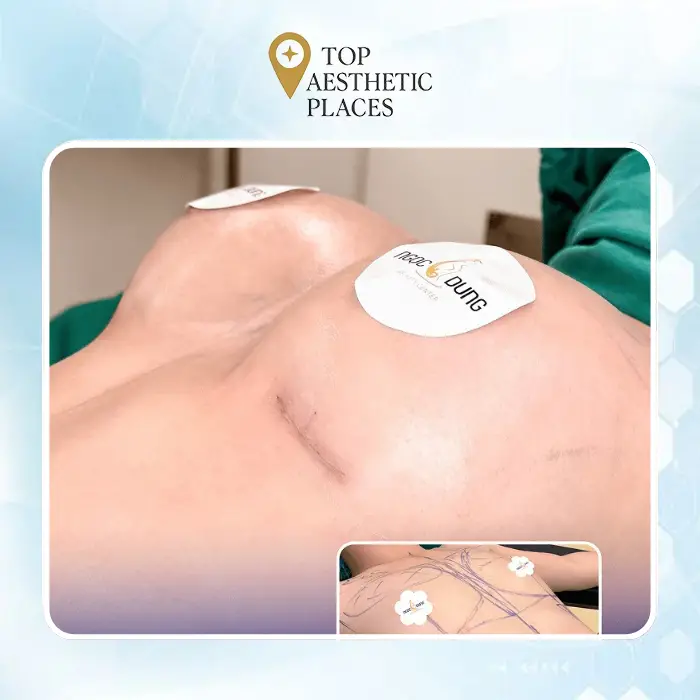 Breast Augmentation in Dak Lak: Top Reputable Beauty Clinics