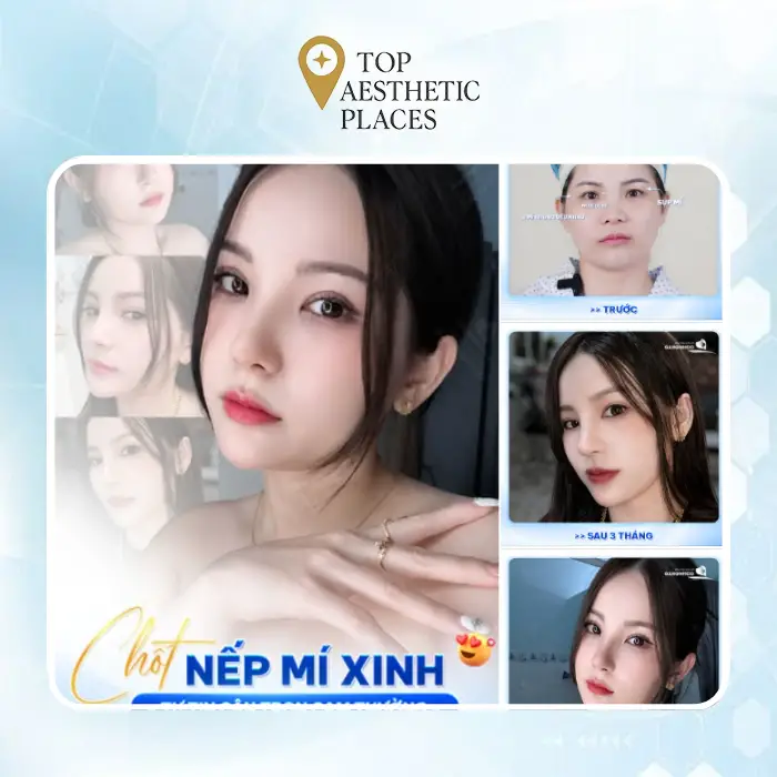 Top 4 Most Popular Eyelid Surgery Clinics in Thu Duc