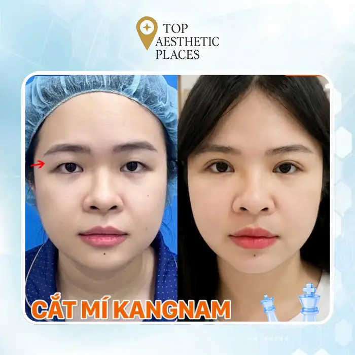 Top 4 Most Popular Eyelid Surgery Clinics in Thu Duc