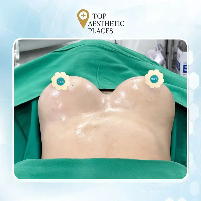 Top 6 Breast Augmentation Clinics in District 6, Ho Chi Minh City