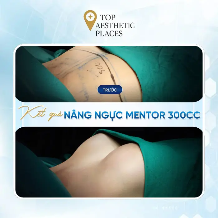Breast Augmentation in Nghe An: A Guide to 4 Beauty Clinics