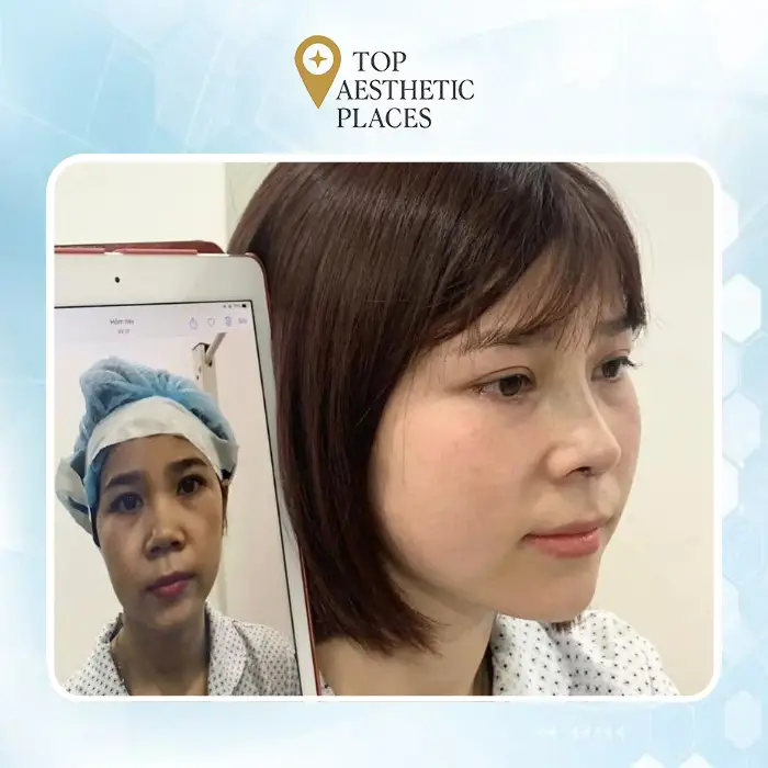 Facelift in Cao Bang 5 Nearby Clinics Worth Considering