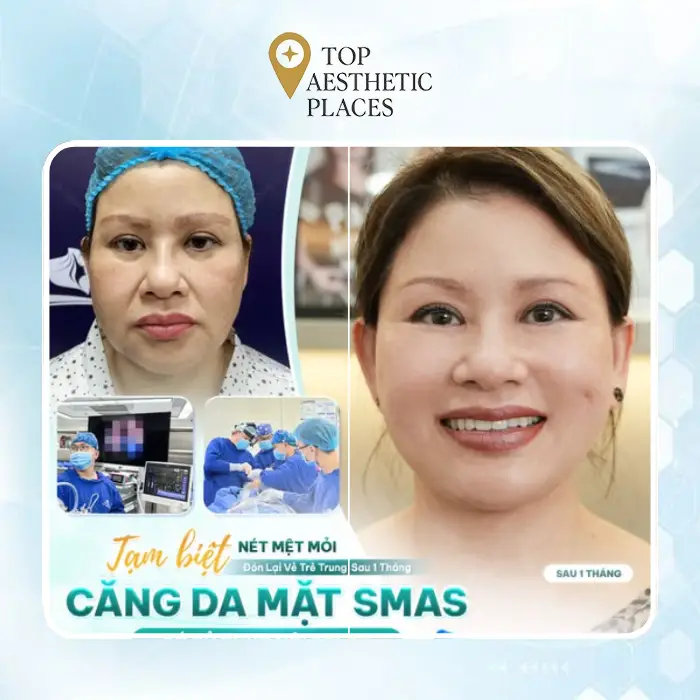 Facelift in District 4 – A Guide to 5 Facial Rejuvenation Addresses
