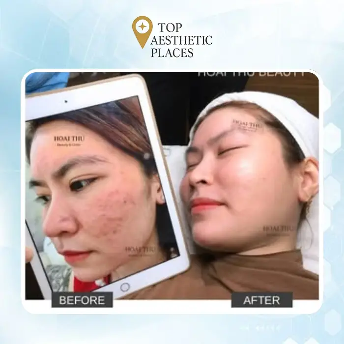 Facelift in Thai Nguyen 3 Places to Consider for Skin Rejuvenation 