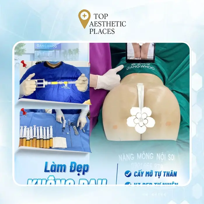 Buttock Augmentation in Binh Duong – 6 Aesthetic Facilities Nearby