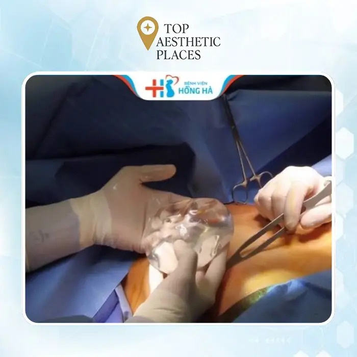 Buttock Augmentation in District 6 – A Guide to 7 Nearby Facilities 